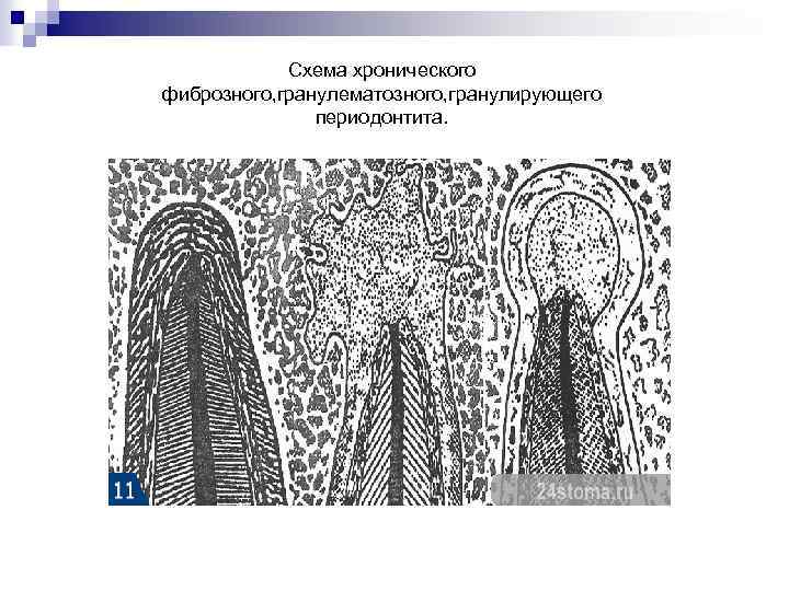 Хронический гранулирующий периодонтит план лечения