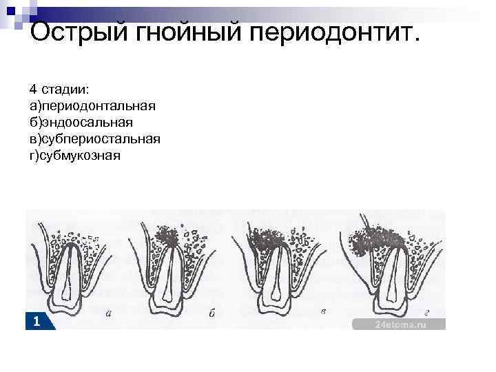 Острый периодонтит. Стадии острого Гнойного периодонтита. Острого Гнойного периодонтита вторая фаза. Острый Гнойный периодонтит фазы. Острый Гнойный периодонтит этапы лечения.