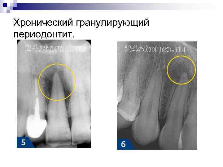 Хронический гранулирующий периодонтит. 