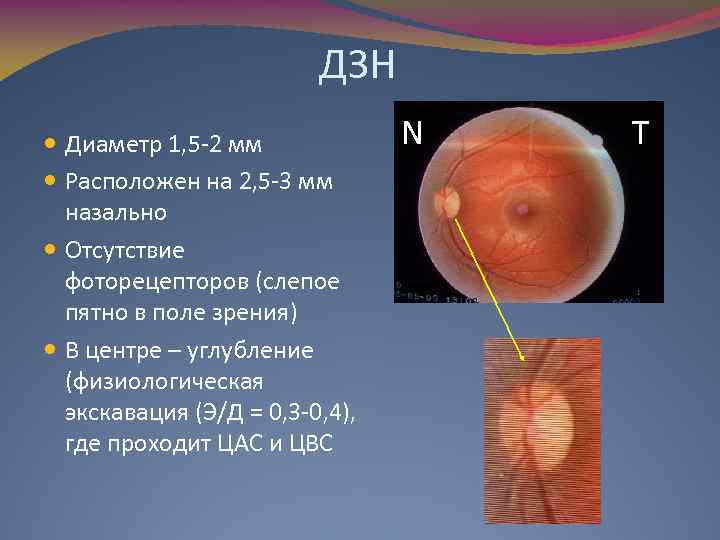 ДЗН Диаметр 1, 5 -2 мм Расположен на 2, 5 -3 мм назально Отсутствие