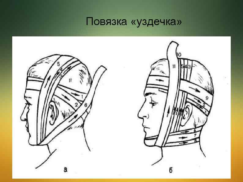 Повязка уздечка накладывается. Десмургия повязка уздечка. Уздечка перевязка. Повязка уздечка схема. Недоуздок повязка.