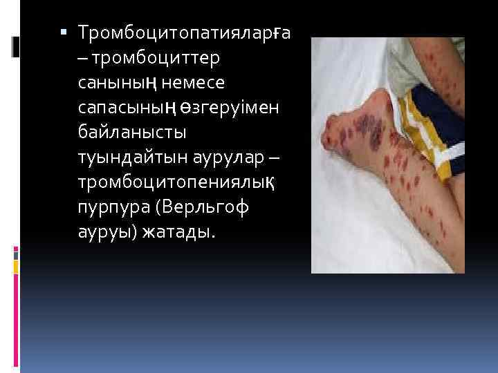  Тромбоцитопатияларға – тромбоциттер санының немесе сапасының өзгеруімен байланысты туындайтын аурулар – тромбоцитопениялық пурпура