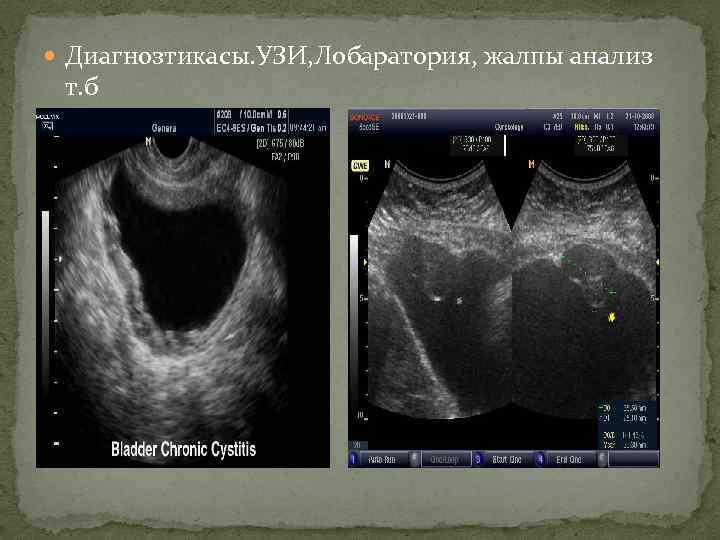  Диагнозтикасы. УЗИ, Лобаратория, жалпы анализ т. б 