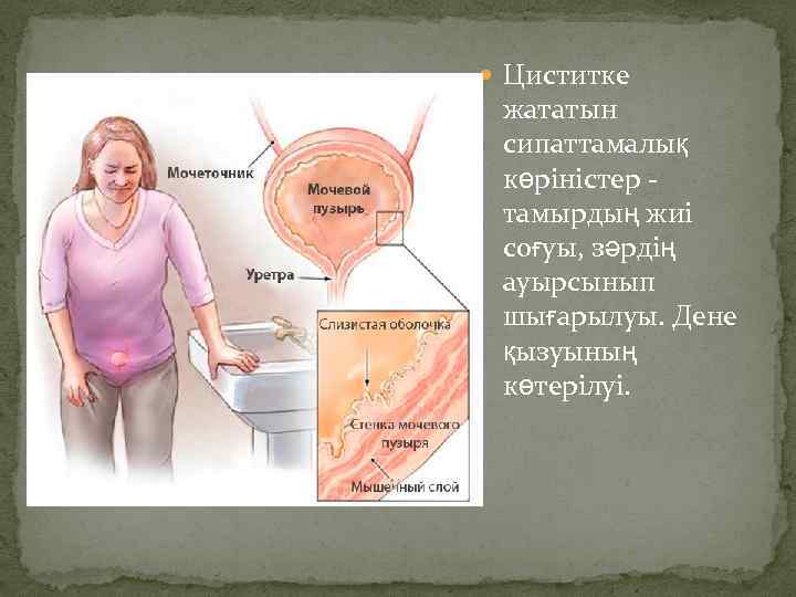  Циститке жататын сипаттамалық көріністер - тамырдың жиі соғуы, зәрдің ауырсынып шығарылуы. Дене қызуының