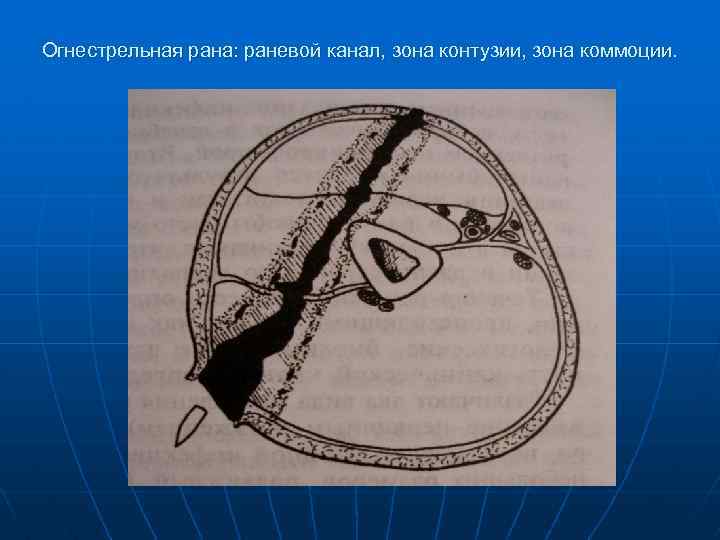 Огнестрельная рана: раневой канал, зона контузии, зона коммоции. 