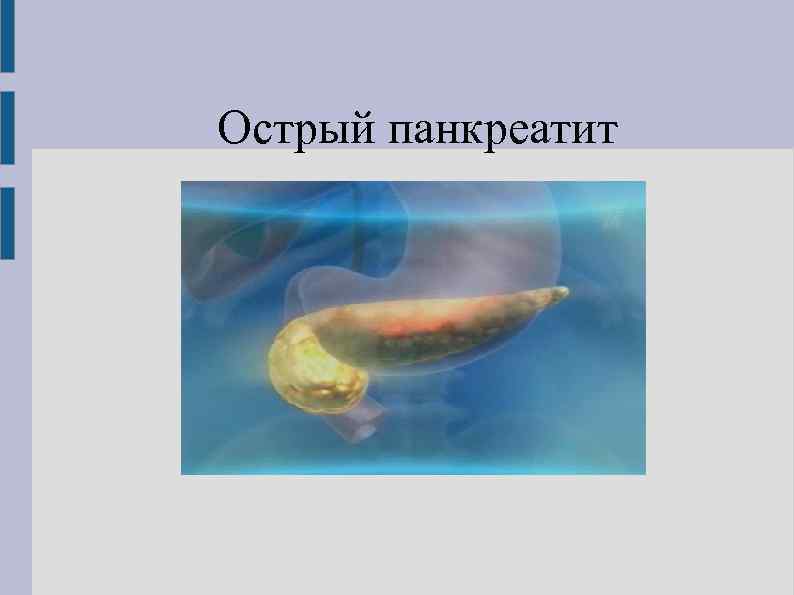 Острый панкреатит 