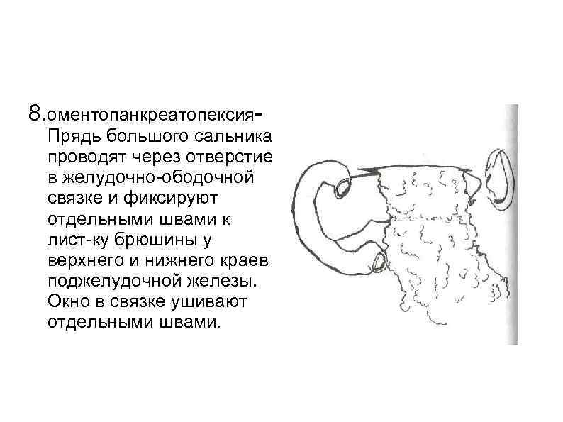8. оментопанкреатопексия Прядь большого сальника проводят через отверстие в желудочно ободочной связке и фиксируют