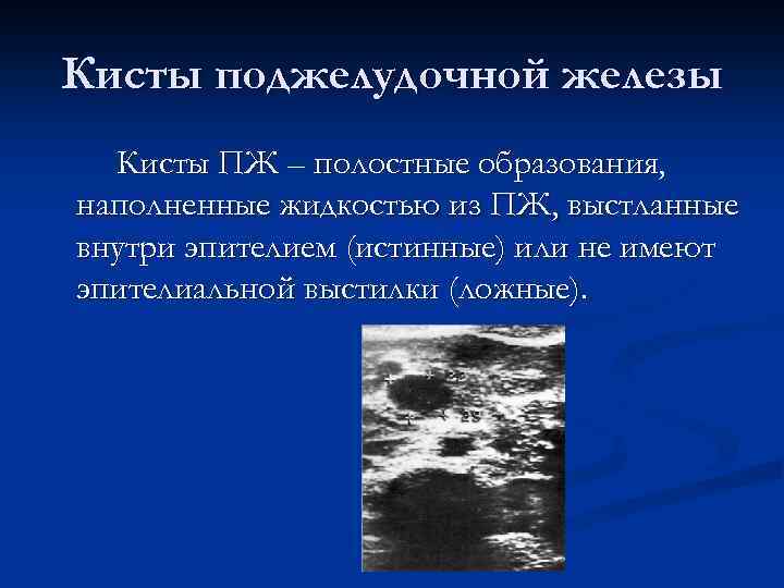 Кисты поджелудочной железы Кисты ПЖ – полостные образования, наполненные жидкостью из ПЖ, выстланные внутри