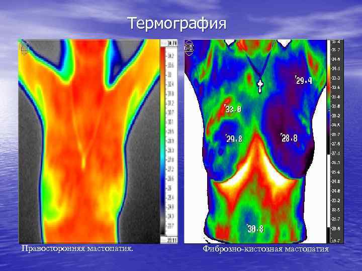  Термография Правосторонняя мастопатия. Фиброзно-кистозная мастопатия 