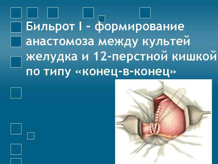 Бильрот I - формирование анастомоза между культей желудка и 12 -перстной кишкой по типу