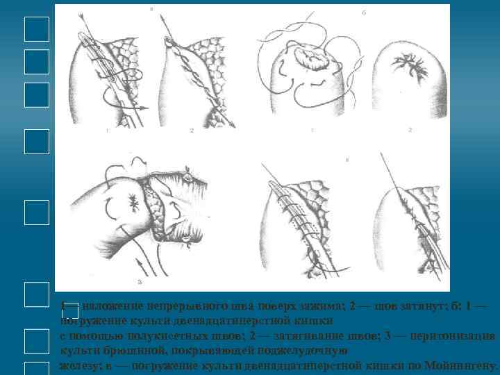 1— наложение непрерывного шва поверх зажима; 2 — шов затянут; б: 1 — погружение