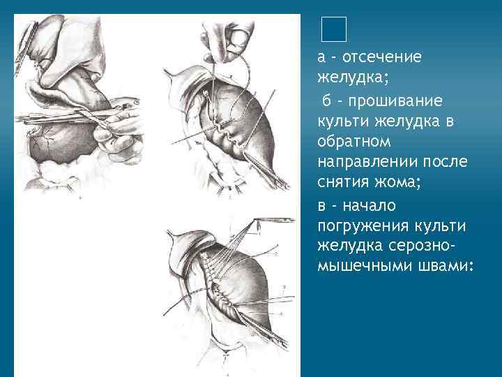 а - отсечение желудка; б - прошивание культи желудка в обратном направлении после снятия