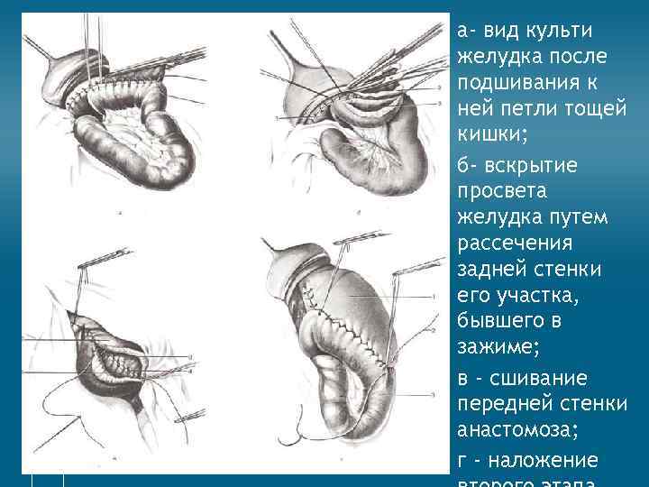  • а- вид культи желудка после подшивания к ней петли тощей кишки; •