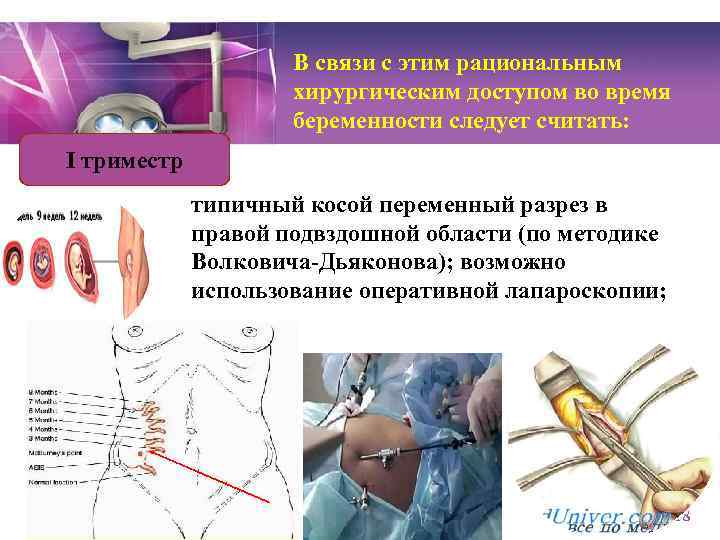 Как врачи определяют аппендицит при беременности