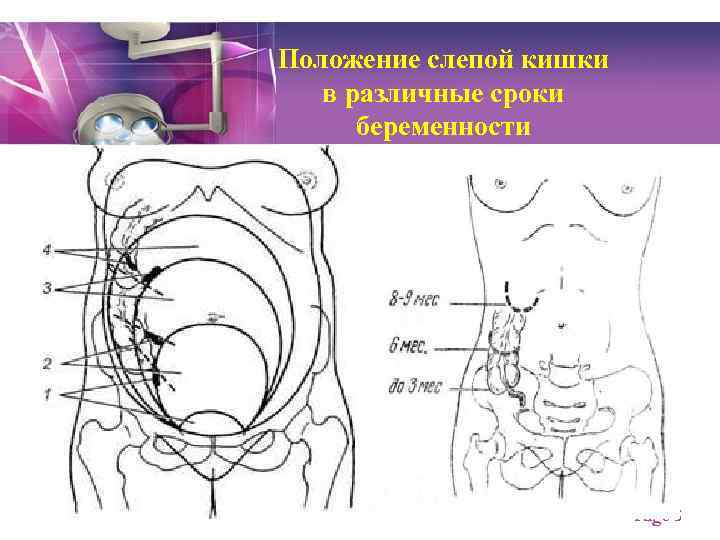 Положение слепой кишки в различные сроки беременности Page 5 