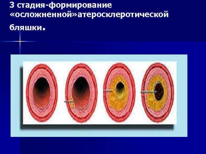 3 стадия-формирование «осложненной» атеросклеротической бляшки. 