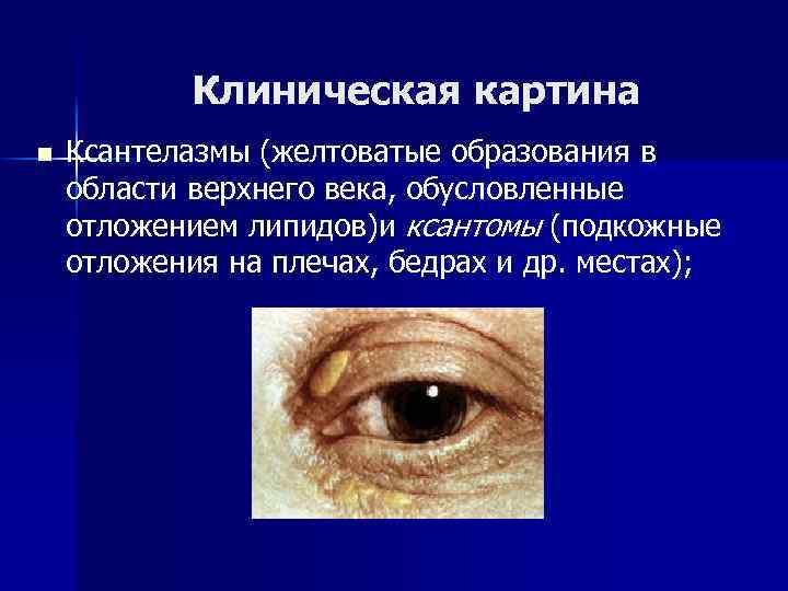 Клиническая картина n Ксантелазмы (желтоватые образования в области верхнего века, обусловленные отложением липидов)и ксантомы