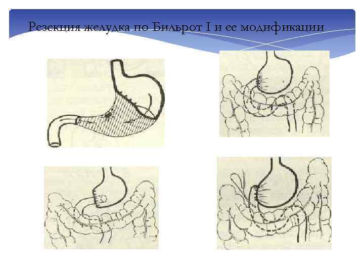 Резекция желудка по Бильрот I и ее модификации 