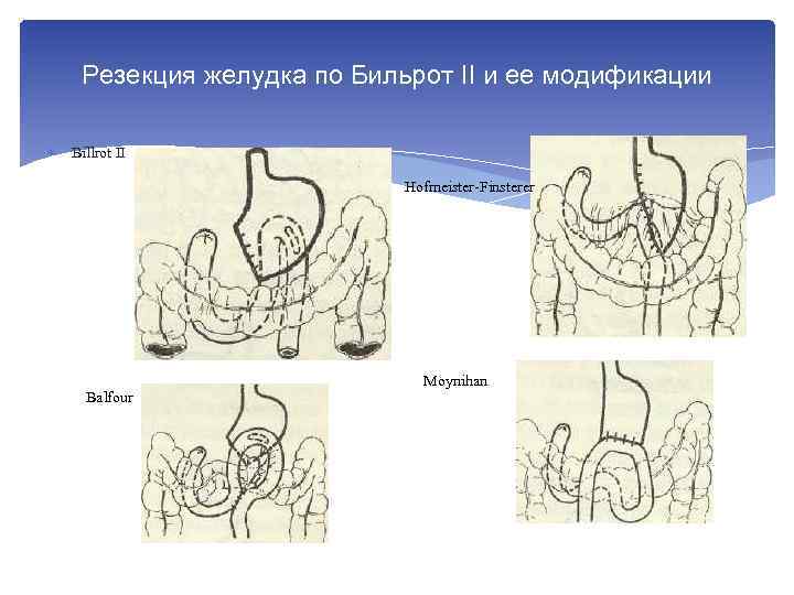 Резекция желудка по Бильрот II и ее модификации Billrot II Hofmeister Finsterer Balfour Moynihan