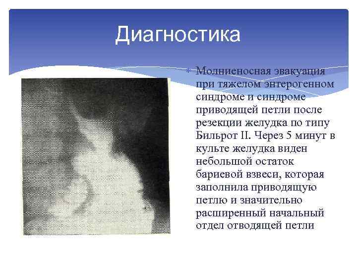 Диагностика Молниеносная эвакуация при тяжелом энтерогенном синдроме и синдроме приводящей петли после резекции желудка