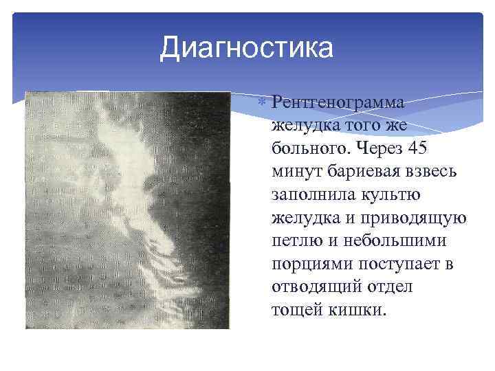 Диагностика Рентгенограмма желудка того же больного. Через 45 минут бариевая взвесь заполнила культю желудка