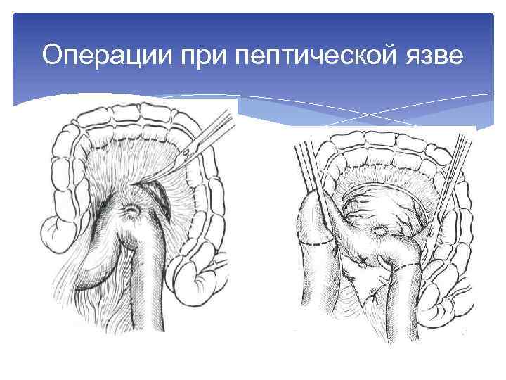 Операции при пептической язве 