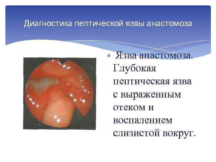 Диагностика пептической язвы анастомоза Язва анастомоза. Глубокая пептическая язва с выраженным отеком и воспалением