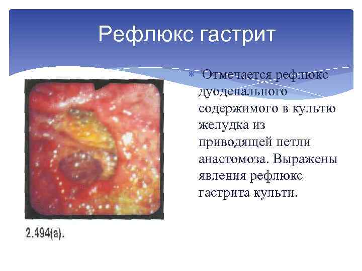 Рефлюкс гастрит Отмечается рефлюкс дуоденального содержимого в культю желудка из приводящей петли анастомоза. Выражены