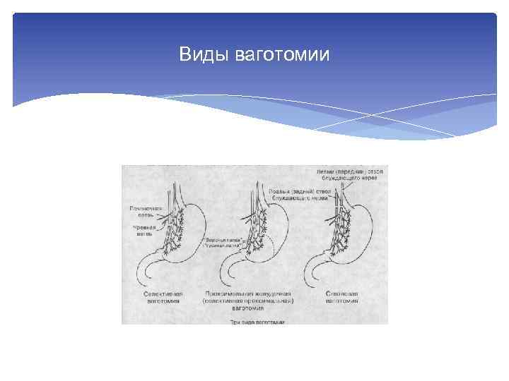 Виды ваготомии 