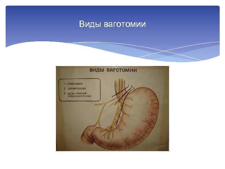 Виды ваготомии 