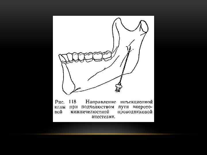 Мандибулярная анестезия схема