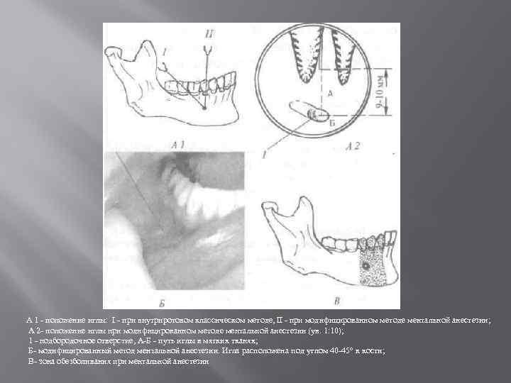 А 1 - положение иглы: I - при внутриротовом классическом методе, II - при