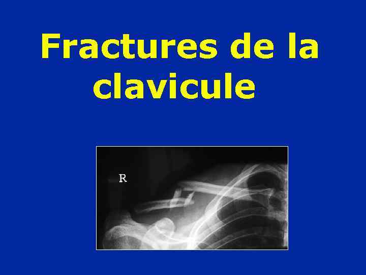 Fractures de la clavicule 