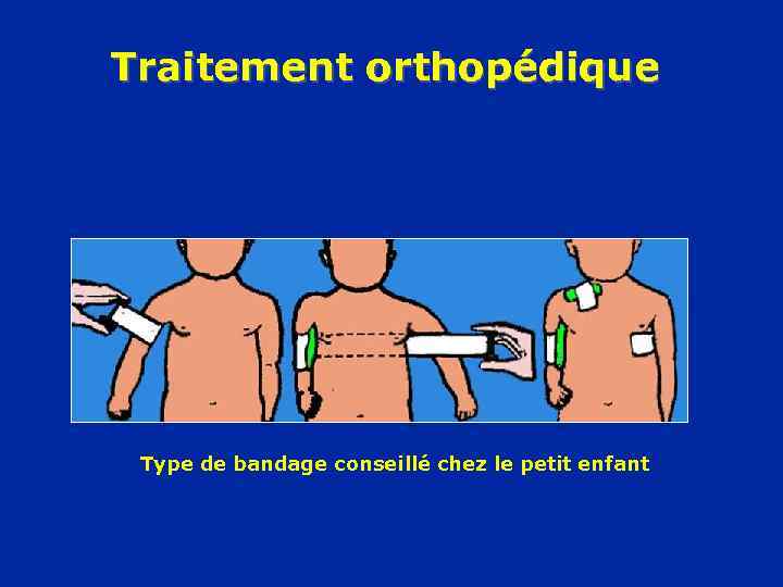 Traitement orthopédique Type de bandage conseillé chez le petit enfant 