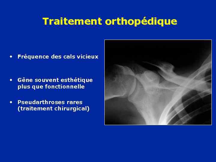 Traitement orthopédique • Fréquence des cals vicieux • Gêne souvent esthétique plus que fonctionnelle