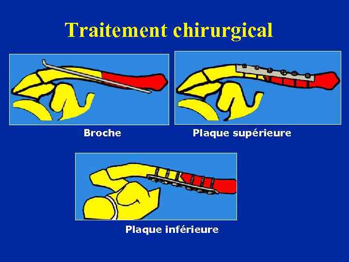 Traitement chirurgical Broche Plaque supérieure Plaque inférieure 