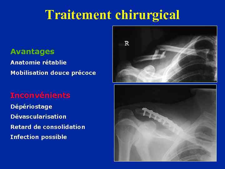 Traitement chirurgical Avantages Anatomie rétablie Mobilisation douce précoce Inconvénients Dépériostage Dévascularisation Retard de consolidation