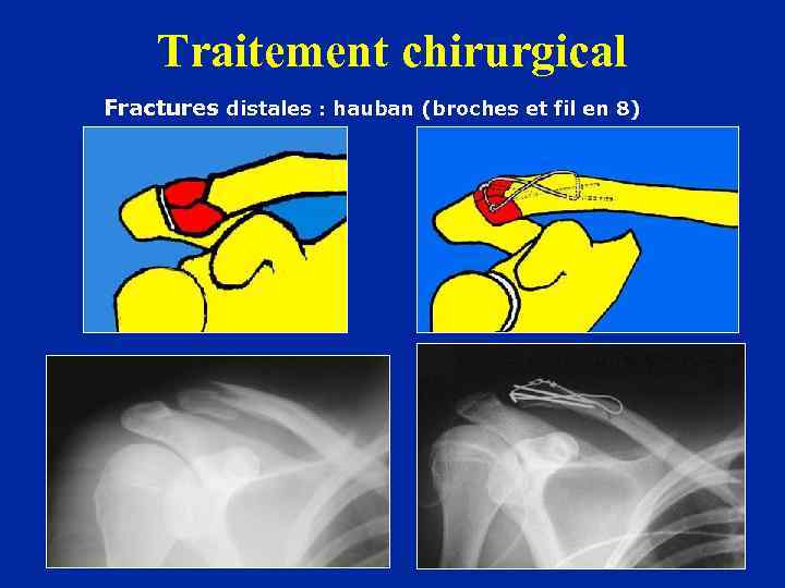 Traitement chirurgical Fractures distales : hauban (broches et fil en 8) 