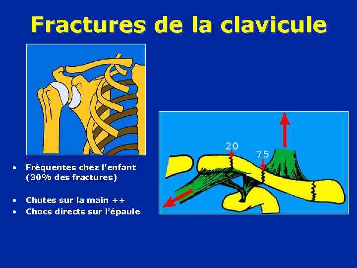 Fractures de la clavicule • Fréquentes chez l’enfant (30% des fractures) • • Chutes