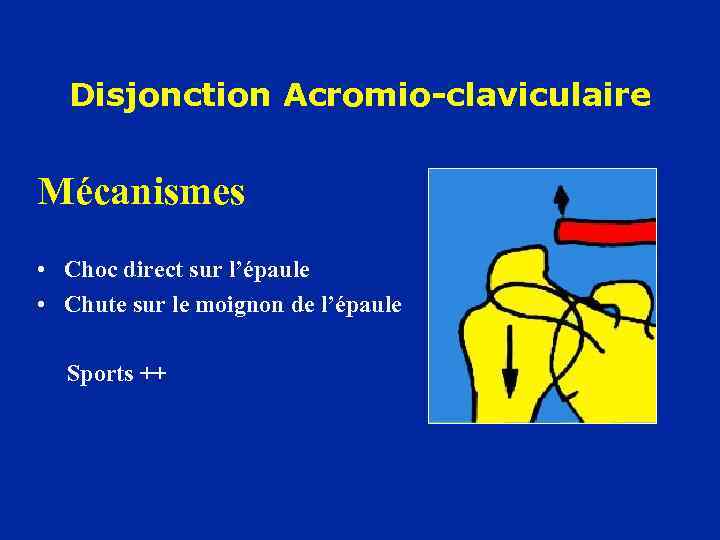 Disjonction Acromio-claviculaire Mécanismes • Choc direct sur l’épaule • Chute sur le moignon de