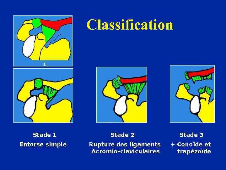 Classification Stade 1 Entorse simple Stade 2 Rupture des ligaments Acromio-claviculaires Stade 3 +