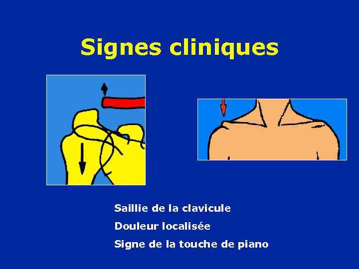 Signes cliniques Saillie de la clavicule Douleur localisée Signe de la touche de piano