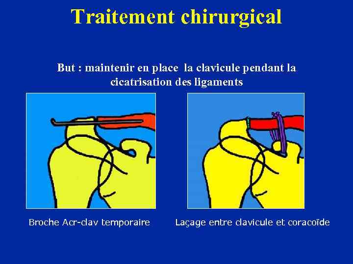 Traitement chirurgical But : maintenir en place la clavicule pendant la cicatrisation des ligaments