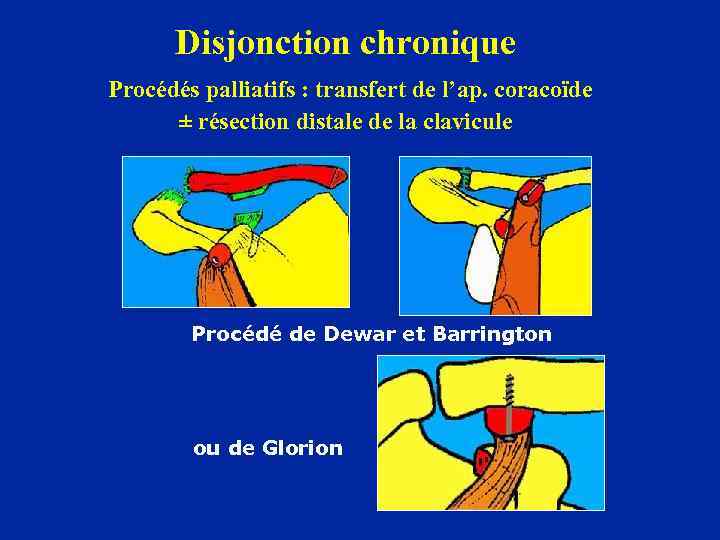 Disjonction chronique Procédés palliatifs : transfert de l’ap. coracoïde ± résection distale de la