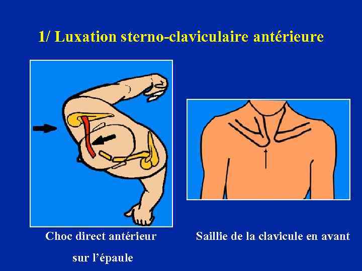 1/ Luxation sterno-claviculaire antérieure Choc direct antérieur sur l’épaule Saillie de la clavicule en