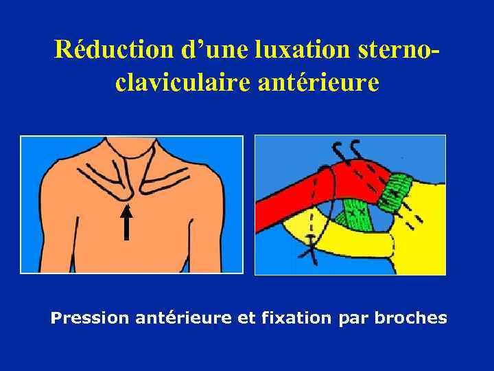 Réduction d’une luxation sternoclaviculaire antérieure Pression antérieure et fixation par broches 