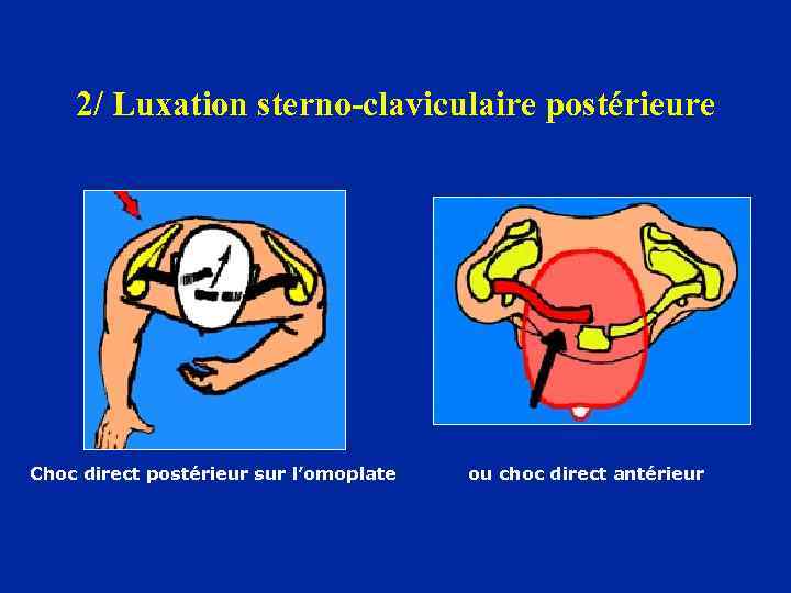 2/ Luxation sterno-claviculaire postérieure Choc direct postérieur sur l’omoplate ou choc direct antérieur 