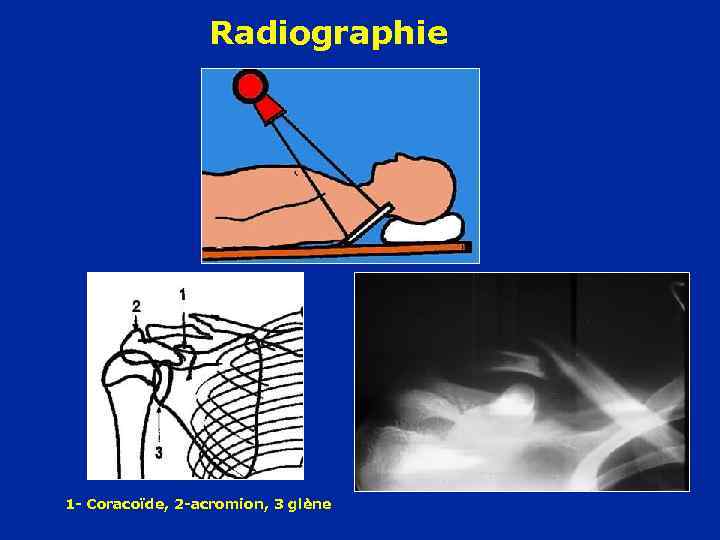 Radiographie 1 - Coracoïde, 2 -acromion, 3 glène 