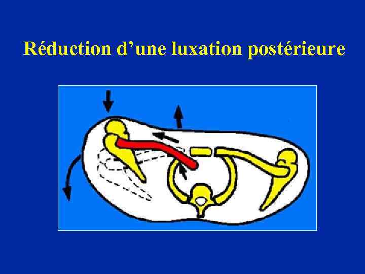 Réduction d’une luxation postérieure 