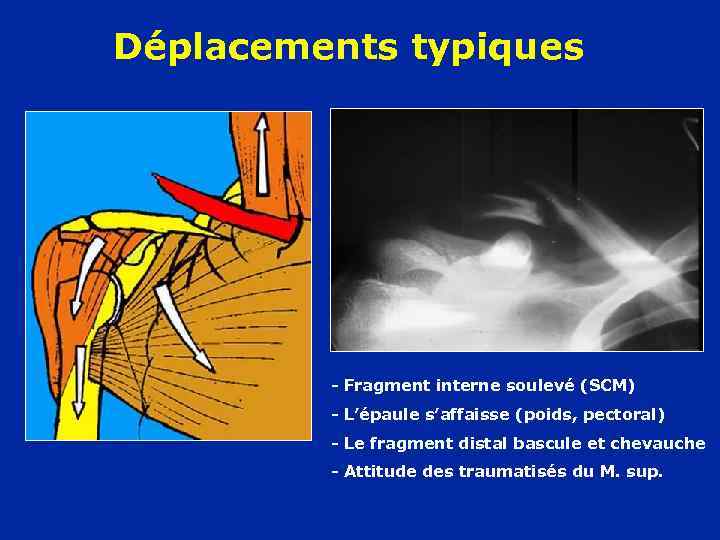 Déplacements typiques - Fragment interne soulevé (SCM) - L’épaule s’affaisse (poids, pectoral) - Le